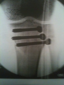 X-ray image of DVT Survivor Mike Fitzgerald